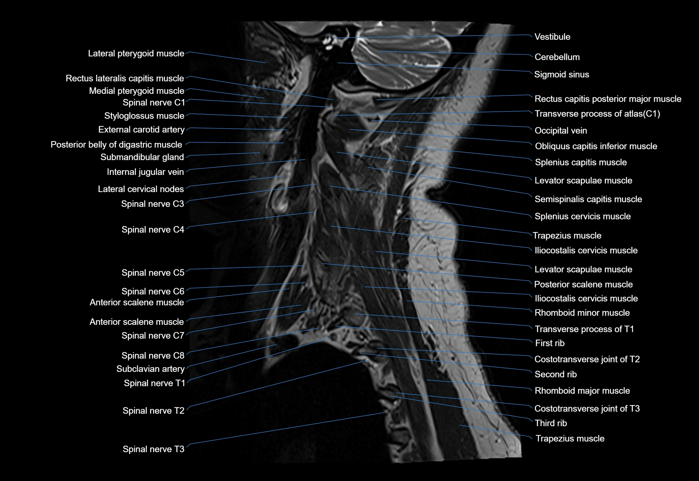 cervical spine cross sectional MRI anatomy 3T MRI  sagittal image-img-00001-00002.webp